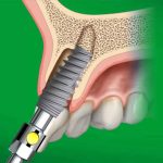 nobelactive implant