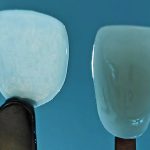 Thinnest Cosmetic Dental Veneer