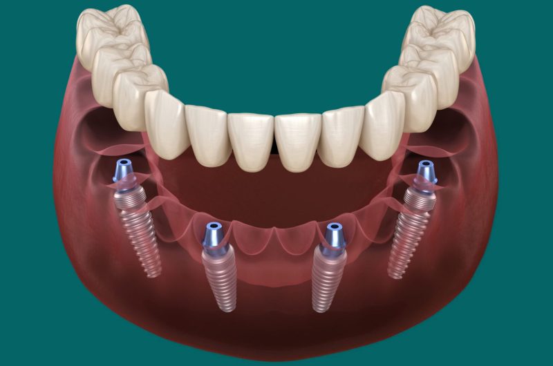 all on 4 dental implants