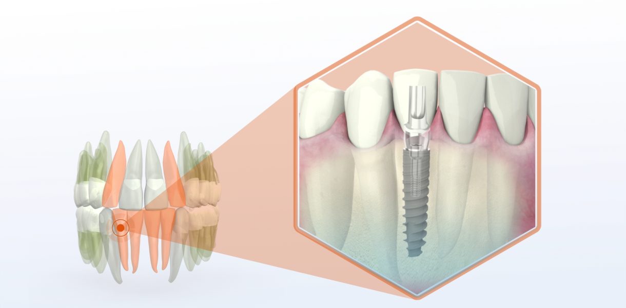 mini dental implants