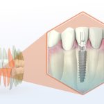 mini dental implants
