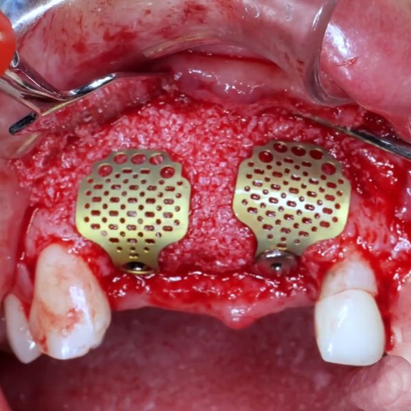 Titanium Mesh Membrane - Image 2
