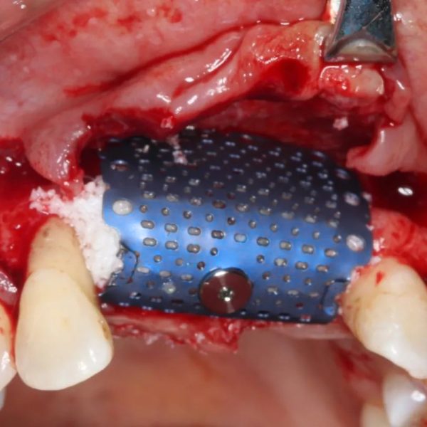 Titanium Mesh Membrane - Image 3