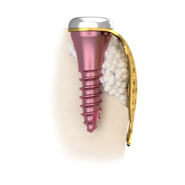 Membrane Fixation Screw - Image 2
