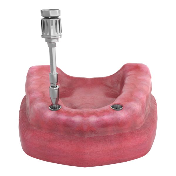 Nobel Biocare Locator Abutment Conical Connection Compatible - Image 5