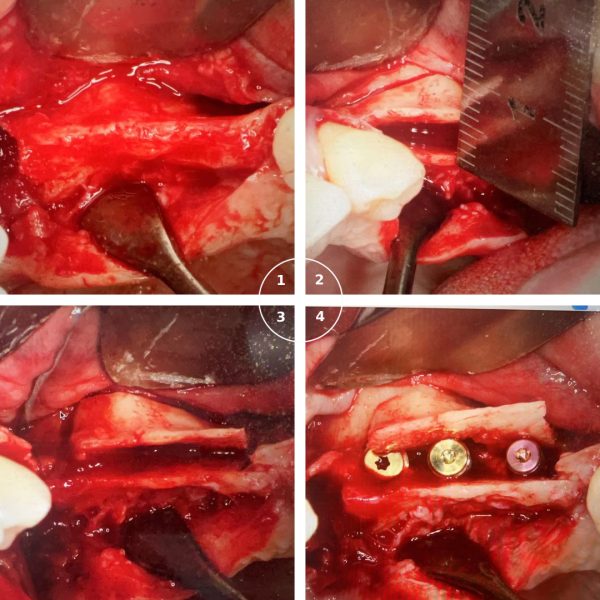 Alveolar Ridge Split & Expansion Kit - Image 2