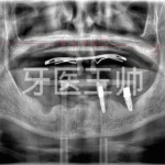 Compatible with BICON's Tap-in Short Implants – Half-Arch Case Sharing-2