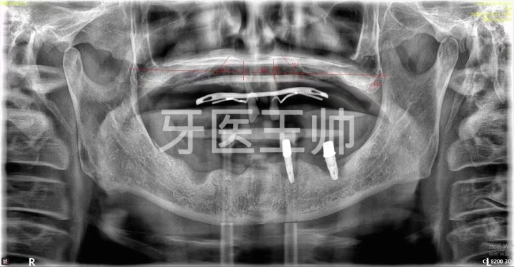 Compatible with BICON's Tap-in Short Implants – Half-Arch Case Sharing-2