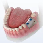 What is a dental bone graft?