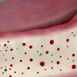 Why Are Decortication Holes Essential in Bone Augmentation Surgery?