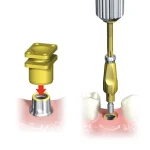 Is there a compatible impression coping for Nobel NP implants?